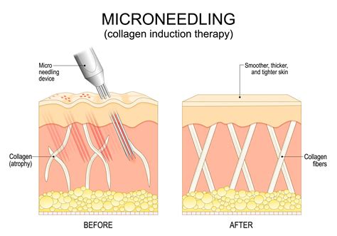 Microneedling process