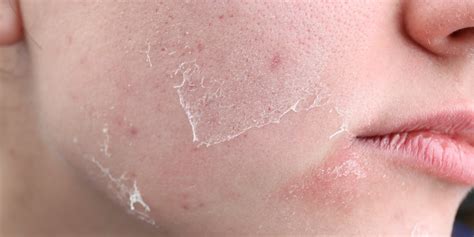 Unveiling the Untold Story Behind the Cracks: Mesmerizing Images of Dry Skin You Won't Want to Miss