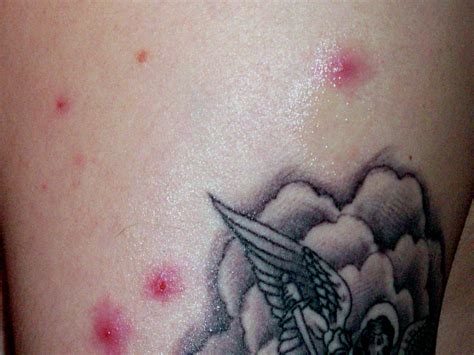 Images Of Infected Tattoos