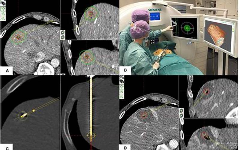 Imaging-Guided Tumor Ablation: Destroying Tumors With Precision