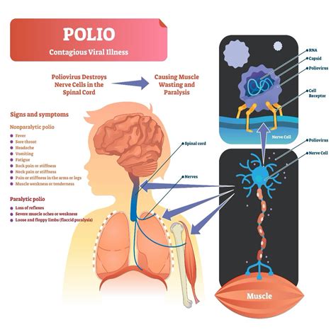 Immediate Effects of Polio Disease