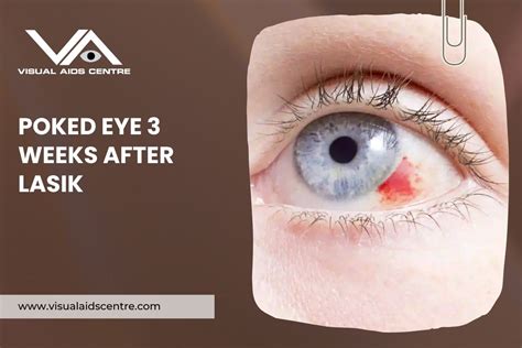 Immediate Steps After a Big Eye Poke