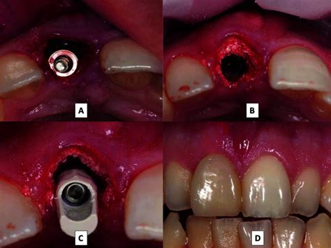 Immediate post-extraction period