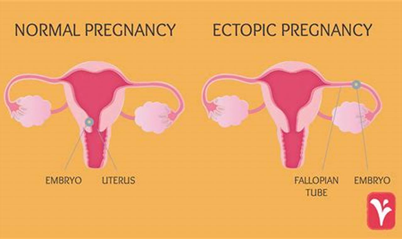 Impact on future fertility: ectopic pregnancy