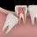 Impacted Tooth Meaning