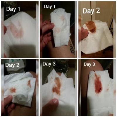 Implantation Bleeding On Tissue