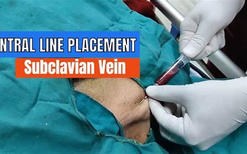 Importance Of Central Line Placement