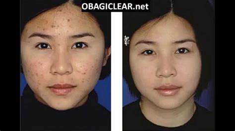 Important Tips for Using Obagi Clear