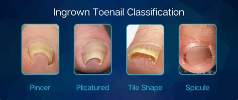In Grown Toenail