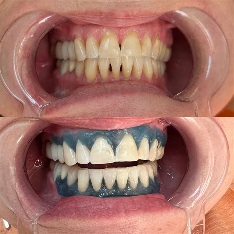 In-Office Chairside Whitening