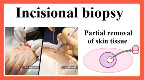Incisional Biopsy Test and interpretation