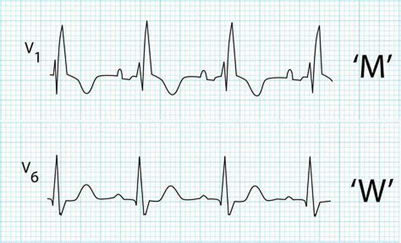 Incomplete Right Bundle Branch Block Pattern