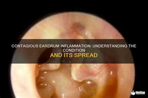 Infection In The Eardrum