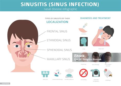 Infeksi Sinus