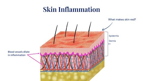 Inflammation and Redness