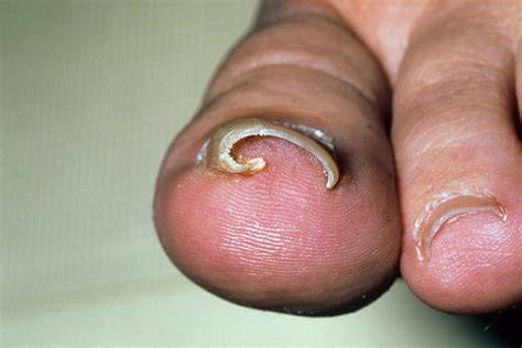 Ingrown Nail Toe