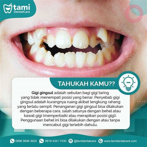 Inilah Harga Cabut Gigi Gingsul Terkini