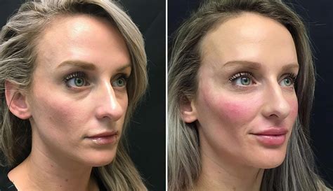 Injectables and Fillers