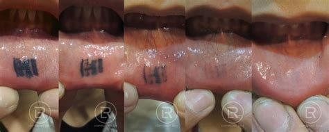 GO! Tattoo Removal • The inner lower lip tattoo typically