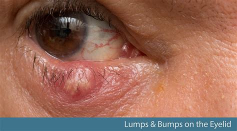 Inner Eye Lumps: Causes & Prevention Tips