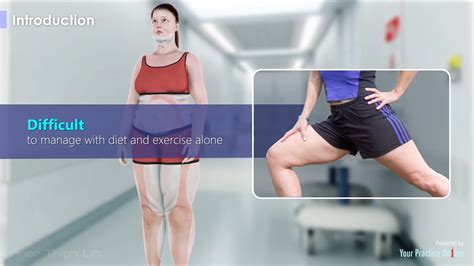 Revitalize Your Inner Beauty with Inner Thigh Liposuction: The Ultimate Solution to Banish Sagging Skin!