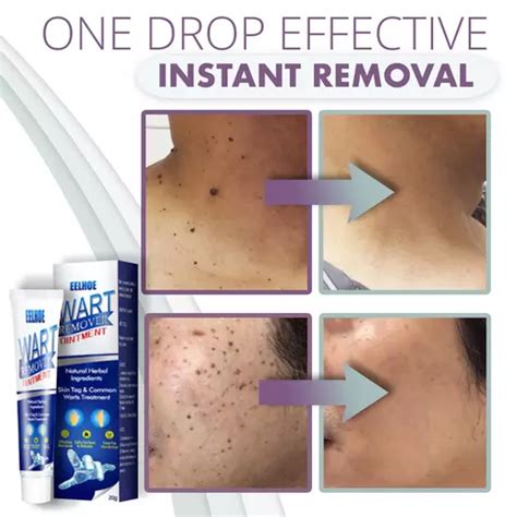 Unveil Your Flawless Skin: Experience the Magic of Instant Skin Tag Removal Mousse