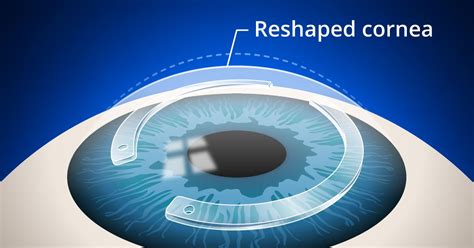 Intacs Implants: Reshaping the Cornea