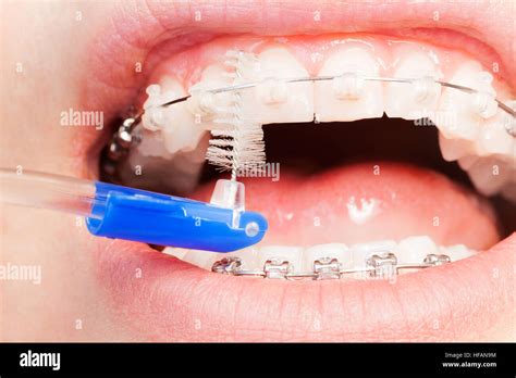Interdental brushes with braces