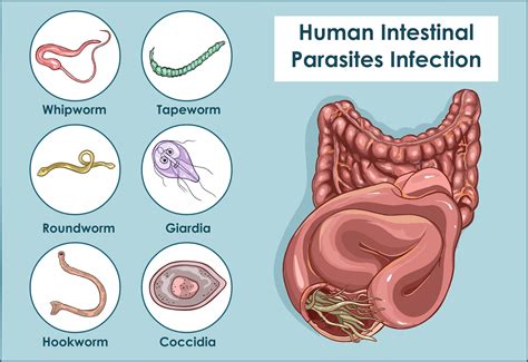Intestinal Parasites Causing Hunger