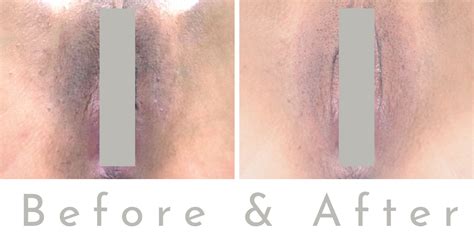 Glowing Secrets: Find the Best Intimate Skin Lightening Near Your Location