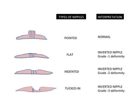 Inverted Nipple Image