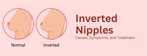 Inverted Nipple Symptoms
