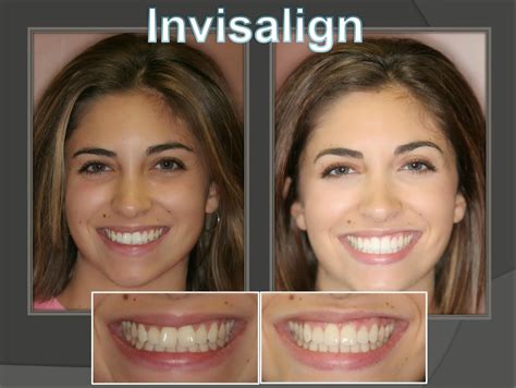 Invisalign before and after
