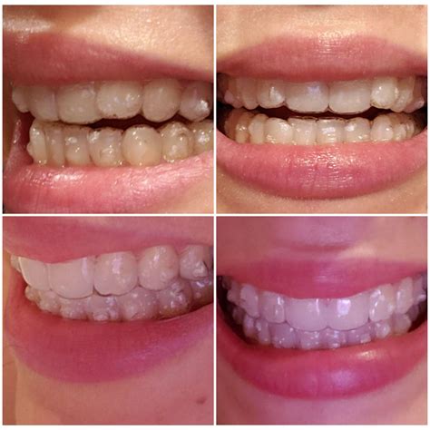 Invisalign progression