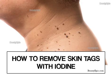 Say Goodbye to Skin Tags with the Power of Iodine: Your Ultimate Guide to Banishing Unwanted Blemishes Naturally!