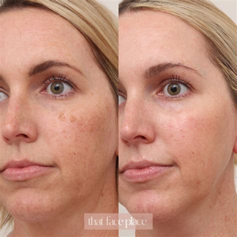 Revitalize Your Skin with IPL Skin Rejuvenation At Home: The Ultimate Guide to Achieving Flawless and Youthful Skin