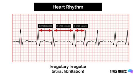 Heart Rhythm Strips