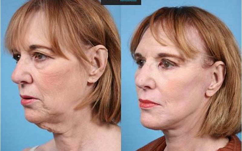 Is A Face Lift Right For You