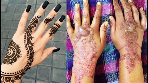 Temporary Black Henna Tattoos Can Be Painfully Permanent