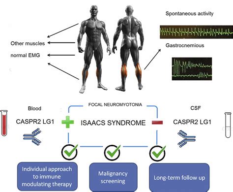 Isaac Syndrome: Control Uncontrolled Muscle Movements.