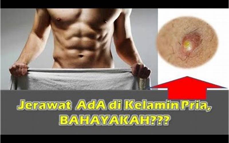 Jerawat Di Alat Kelamin Pria: Apa Yang Harus Dilakukan?