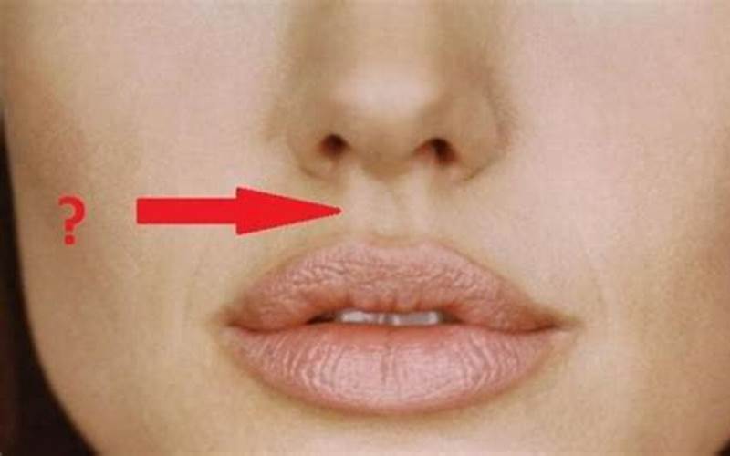 Jerawat Di Antara Hidung Dan Bibir: Apa Yang Harus Dilakukan?