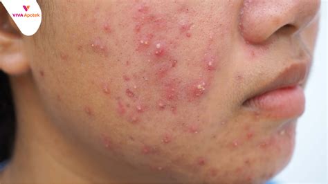 Jerawat Pipi