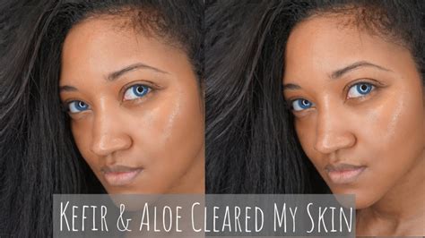 Transform Your Skin with Kefir: Before and After Results