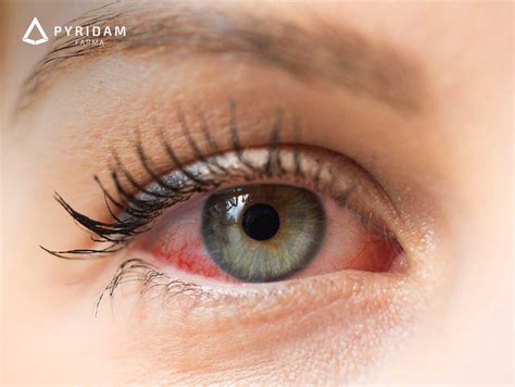 Kenali Penyebab Dan Cara Mengatasi Mata Merah