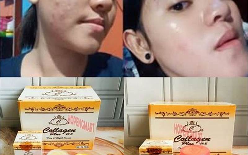 Kenapa Setelah Memakai Cream Collagen Timbul Jerawat?