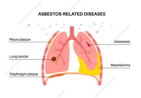 Key Asbestos-Related Diseases