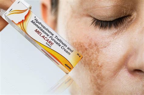 Key Benefits of Using Melacare Cream