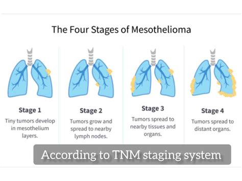 Key Components of Mesothelioma TNM 8