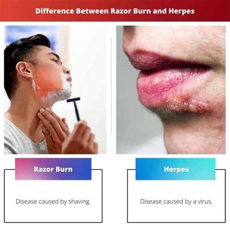 Key Differences: Razor Bumps vs Herpes